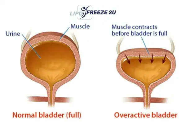 diagram of overactive bladder treatment Newark-on-Trent