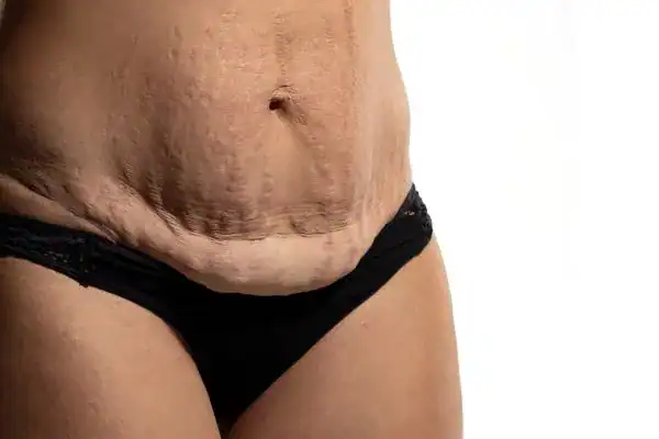 loose skin after weight loss injections Newark-on-Trent
