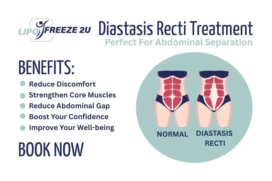 Benefits of body toning treatment Newark-on-Trent for Diastasis recti