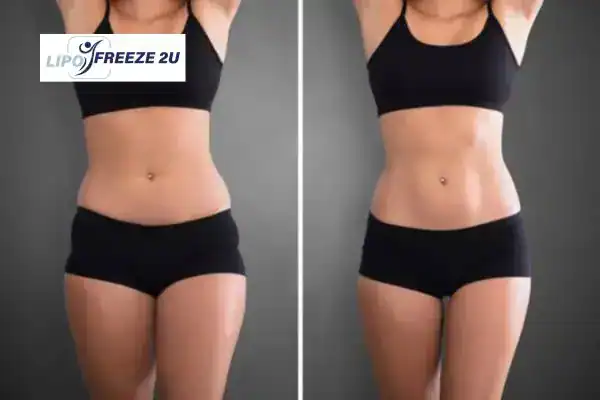 How Can LIPO FREEZE 2U Support Your Post-Pregnancy Body Recovery Newark-on-Trent?