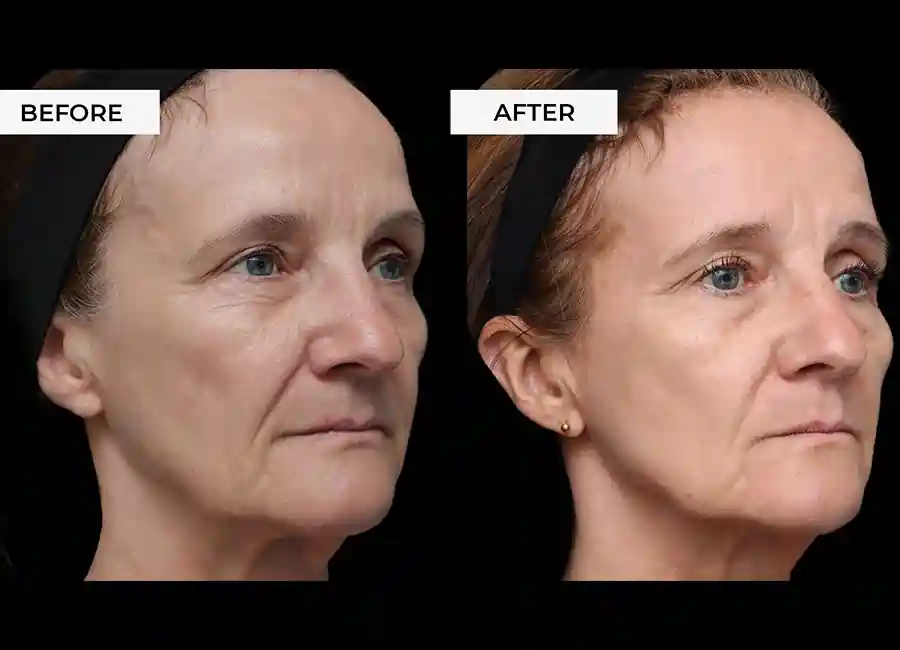 How Many RF Microneedling Sessions Will You Need to See a Difference Newark-on-Trent?