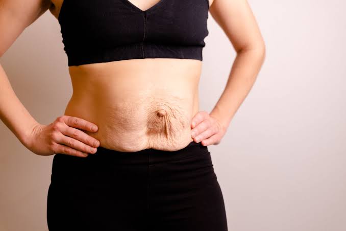 Is Surgery Really the Only Way to Repair Diastasis Recti Newark-on-Trent?