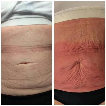 How Does RF Microneedling Improve Crepey, Thin and Uneven Skin Texture Newark-on-Trent?
