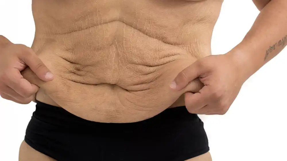 RF Microneedling for Loose Skin: How Can It Help Tighten and Reshape the Skin Newark-on-Trent?
